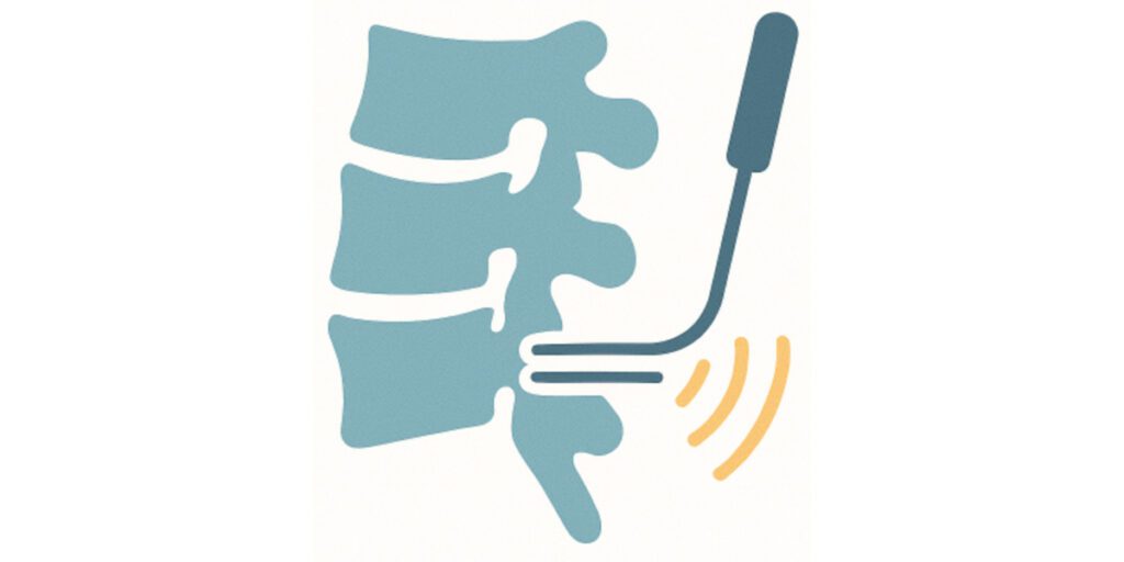 Targeting the lateral neck of superior articular process and sub-mammillary fossa for lumbar medial branch radiofrequency ablation- A case series