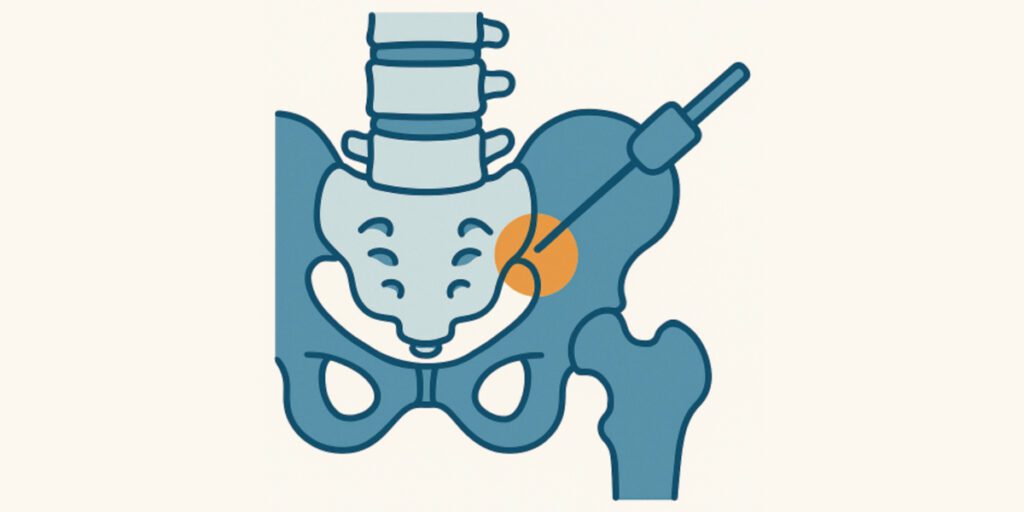 What is the optimal block-selection paradigm for predicting a successful treatment outcome following sacral lateral-branch radiofrequency neurotomy A real - world cohort study