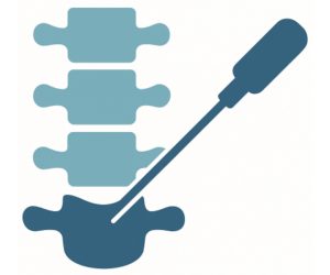 A description and outcome evaluation of sacrococcygeal joint radiofrequency neurotomy for treatment of chronic coccydynia – A dorsal approach