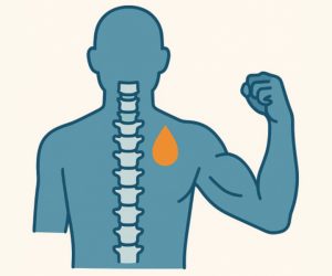 Cervical Spine Platelet-Rich Plasma and Isometric Strength Synergistically Improve Disability in Chronic Whiplash Associated Disorders A Series of Mediation Analyses