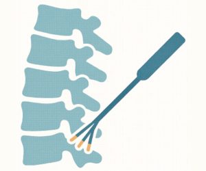 The Effectiveness-of Cervical Medial Branch Radiofrequency Neurotomy Using a Perpendicular Approach-with a Three
