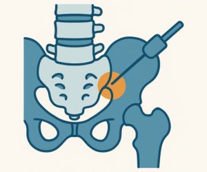 What is the optimal block-selection paradigm for predicting a successful treatment outcome following sacral lateral-branch radiofrequency neurotomy A real - world cohort study
