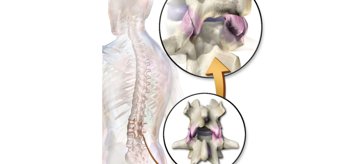 When Do You Trust Imaging Findings for Low Back Pain-1